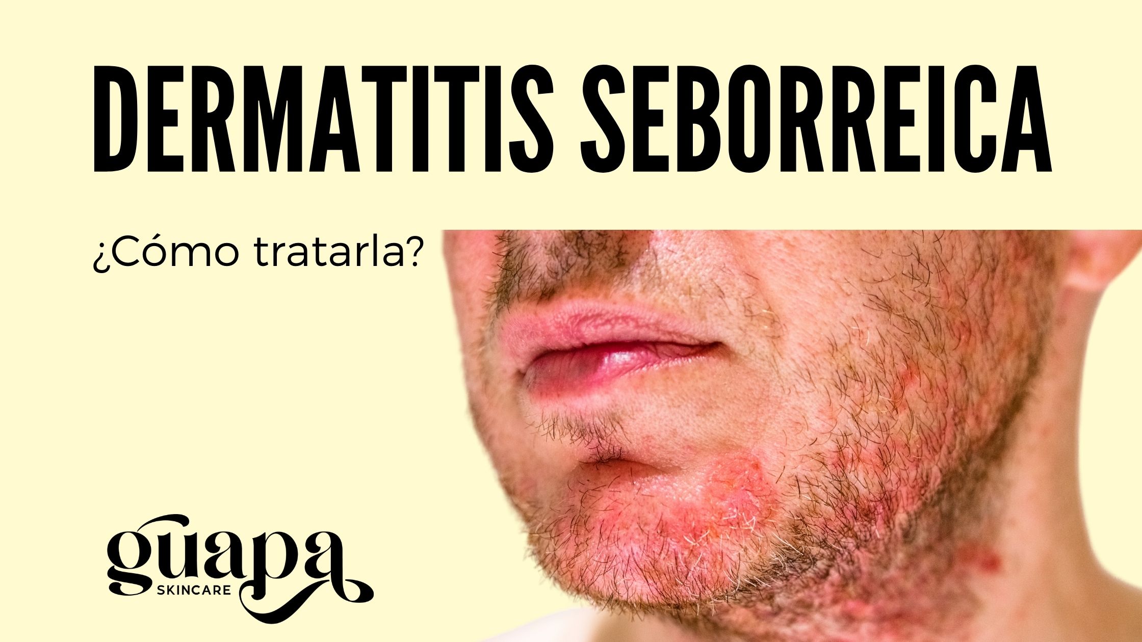 Dermatitis Seborreica ¿Cómo tratarla? -